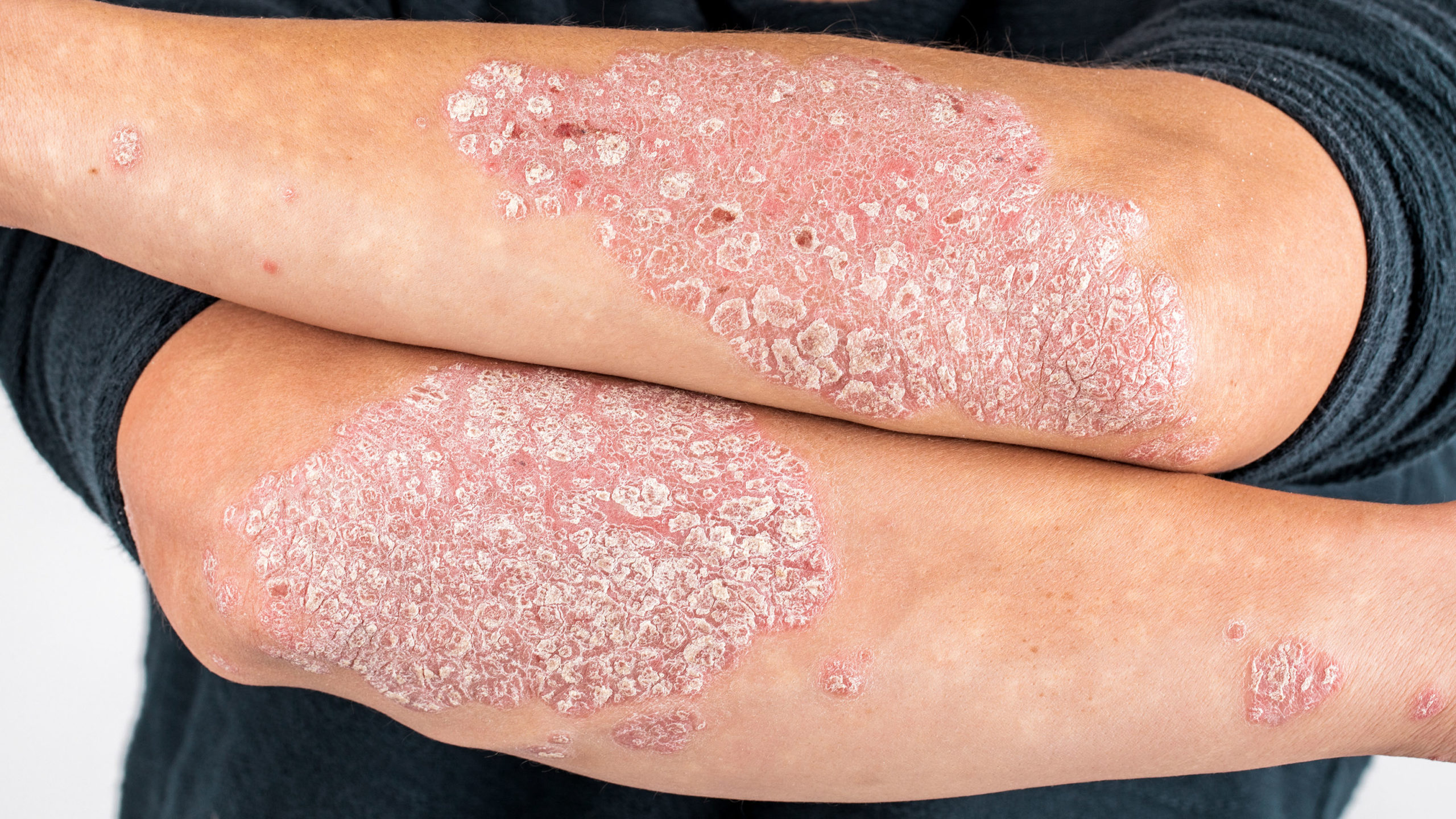 Schuppenflechte (Psoriasis)